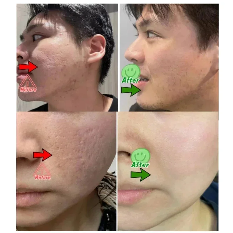 Salicylic Acid Pore Clearing C - Salicylic Acid Blackhead Remover recension och pris